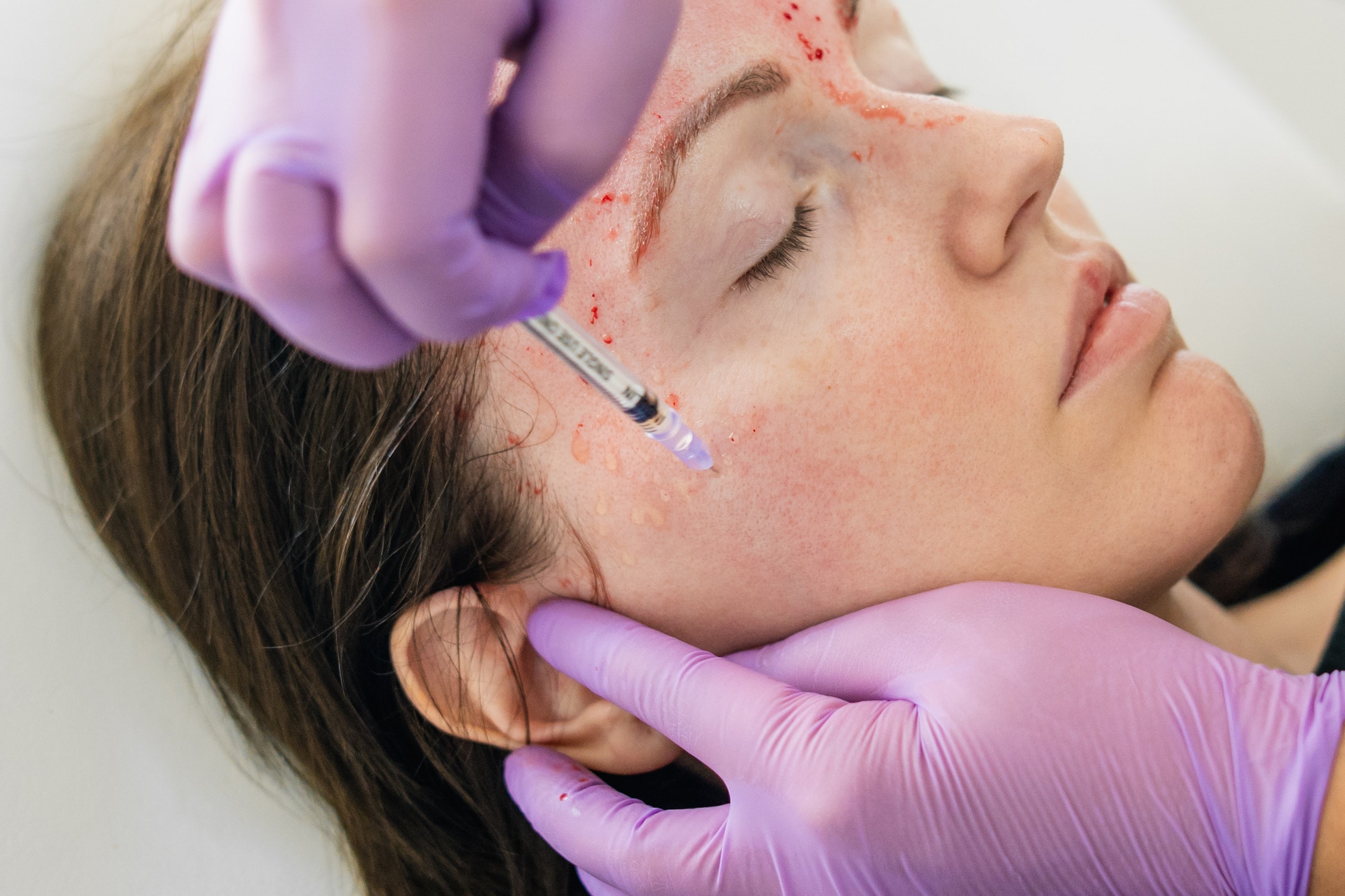 Exosomes & Vampire Face Lift